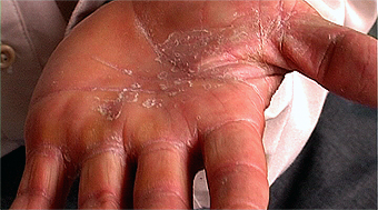 affected hand